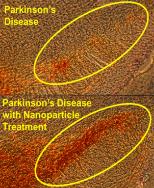 350-inline-2-nanomed-parkinson.png