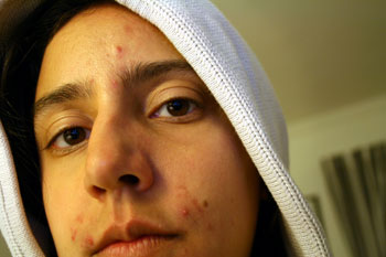 teen with zits