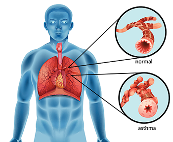 350_inline_asthma_bronchial_tube.png