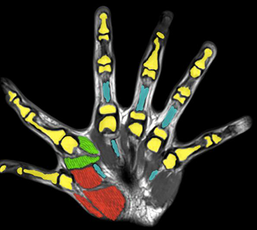 370_six_finger_fmri.png