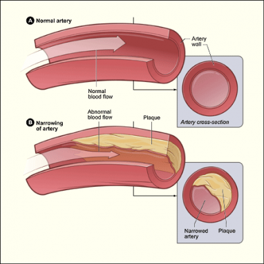 Atherosclerosis diagram