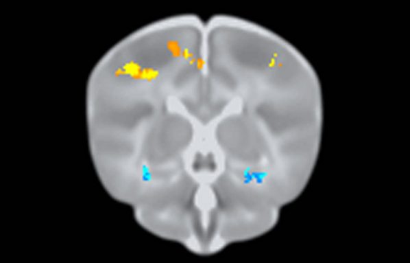 Newborns with a certain version of a gene are more likely to have a smaller medial temporal lobe (blue spots). This brain region is also smaller in adults with Alzheimer’s disease. People with the gene version are three times more likely to develop the disorder, which affects memory.