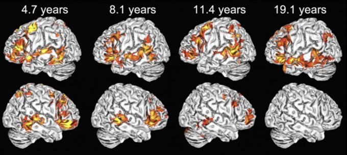 Brain MRIs                               