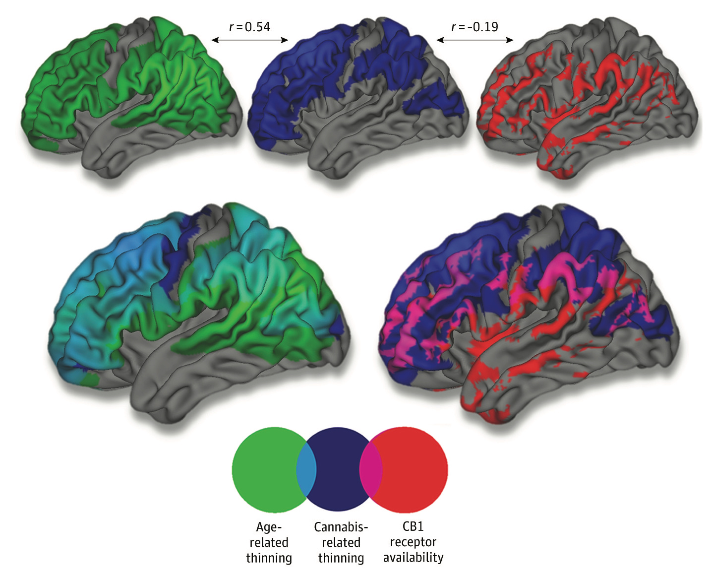 brain maps showing how areas of the brain that thin between 14 and 25 are affected by cannabis