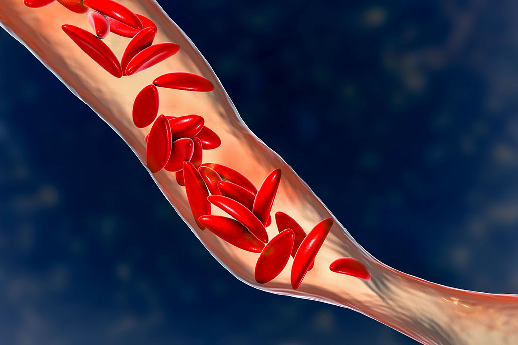 a computer rendered illustration showing how sickled red blood cells get caught in tiny blood vessels, wedging themselves against the blood vessel wall and preventing bloodflow