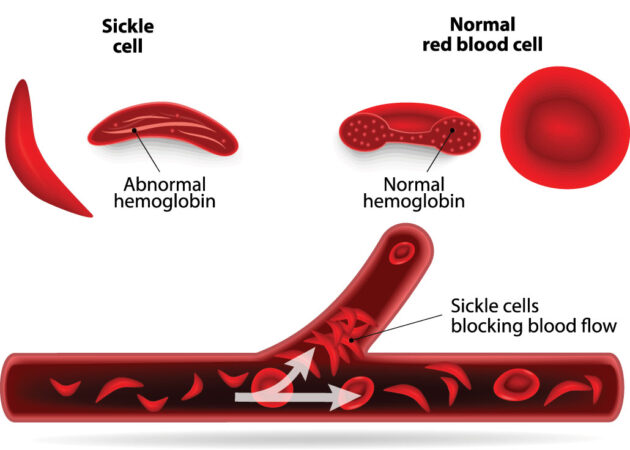 a diagram showing sickle and regular blood cells